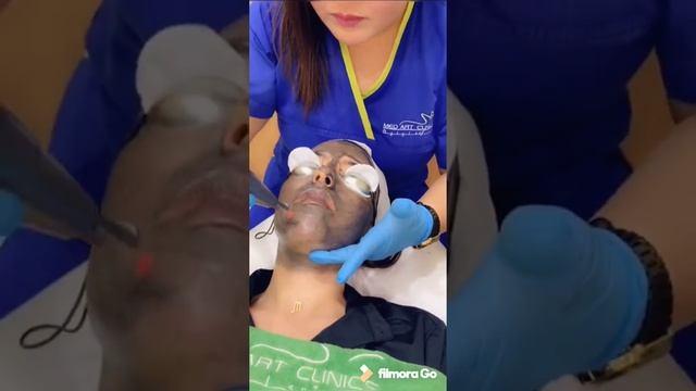 💗 Spectra carbon laser 💗 смотреть онлайн