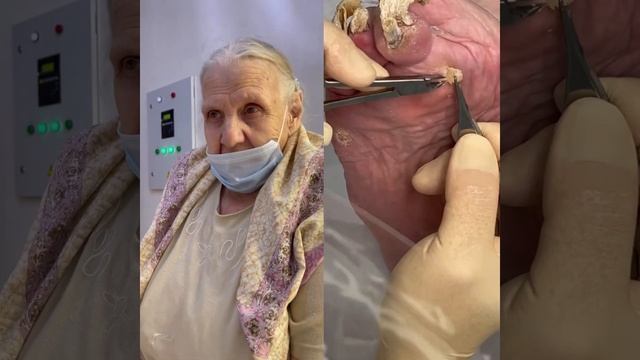 Медицинский педикюр у подолога Татьяны Пак #подологмосква #грибокногтей #онихомикоз