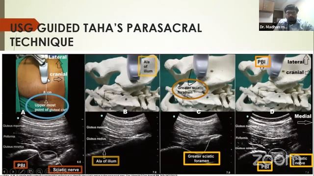 #44 Online Anaesthesia (FEMORAL NERVE BLOCK, SCIATIC NERVE BLOCK and POPLITEAL NERVE BLOCK) смотреть онлайн