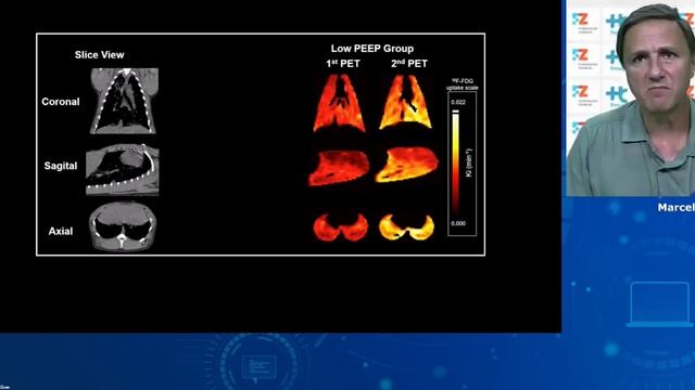 ARDS what is new 2024 webinars ESICM 24