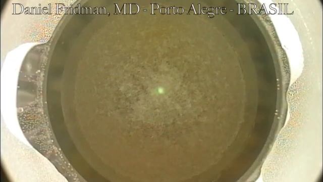 SMILE / Visumax / Zeiss - Cirurgia refrativa com laser de femtossegundo - Dr.Daniel Fridman смотреть онлайн