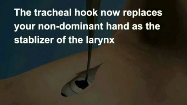 Cricotirotomy sug + Guidewhire 720