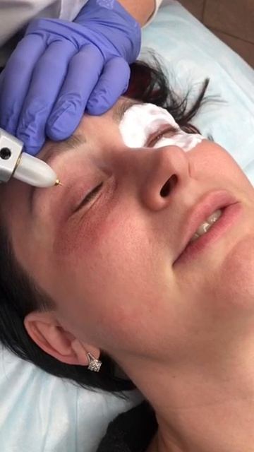 Безоперационная блефаропластика холодной плазмой смотреть онлайн