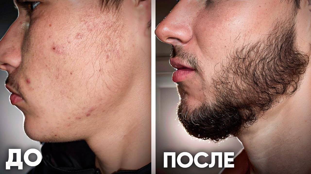 ОТРАСТИЛ СОЛИДНУЮ БОРОДУ за 6 месяцев / результаты Киркланд смотреть онлайн