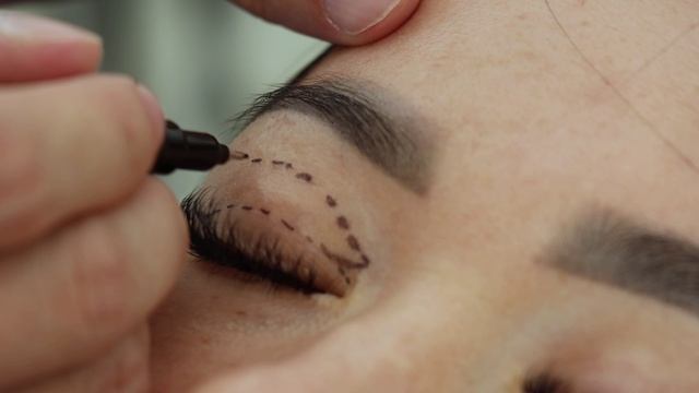 Блефаропластика смотреть онлайн