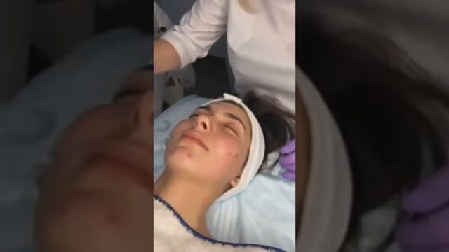 Мезотерапия постакне шрамов