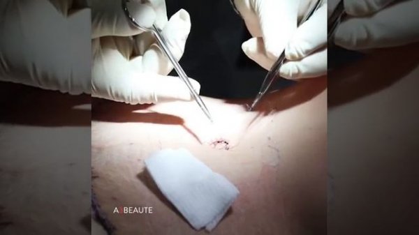 Абдоминопластика. Перевязка. Древецкий.