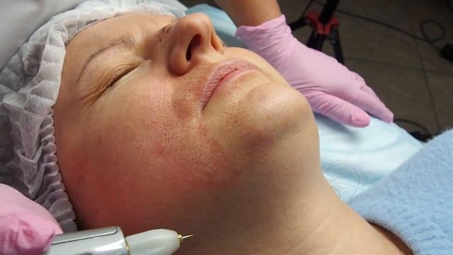 Работа с носогубными складками методом Ablase смотреть онлайн