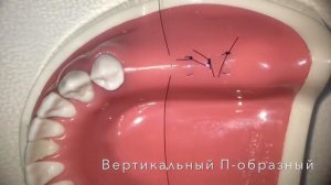 Виды швов при имплантации