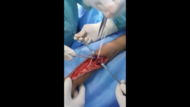 Total radius resection and reconstruction смотреть онлайн