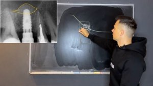 Обучение хирургическим шаблонам в программе RealGuide. Теория.  Введение в имплантологию. Часть 2