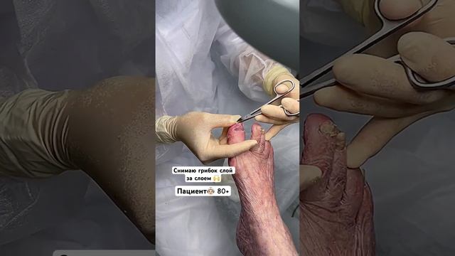 Мне доверяют своих мам |стачиваю грибок слой за слоем не больно! #грибокногтей #подногтем смотреть онлайн