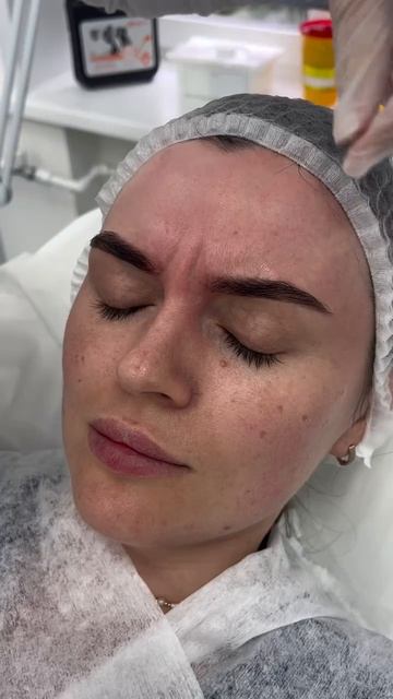 Как проходит процедура ботокса✨#лазернаяэпиляция #депиляция #электроэпиляция #косметология смотреть онлайн