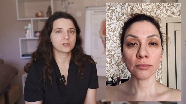 Омоложение лица. Разбор по фото смотреть онлайн