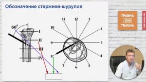 Просто о МУОЧО  Метод унифицированного обозначения чрескостного остеосинтеза (1)