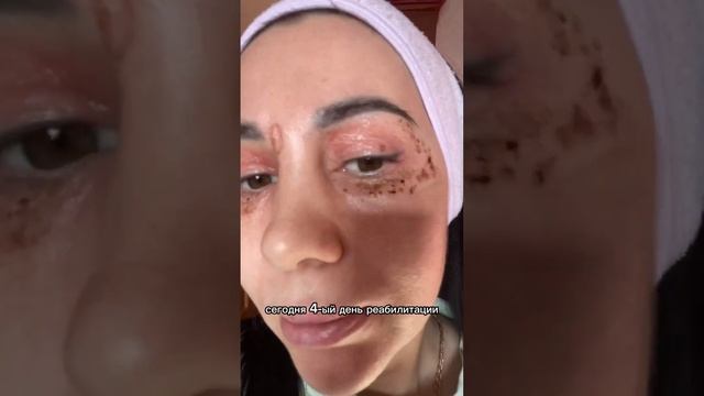 Косметолог Влада Баширова проверяет на себе процедуру безоперационной блефаропластики. смотреть онлайн