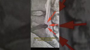 резорбция грыжи межпозвоночного диска