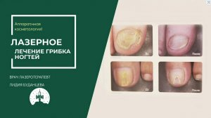 Лазерное лечение грибка ногтей