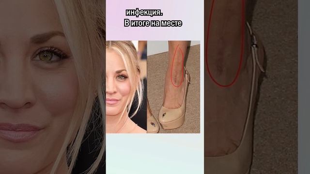 Почему на месте раны иногда остается шрам? смотреть онлайн