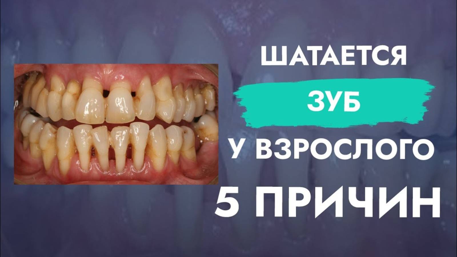 Караул! У зуба появилась подвижность. Причины!