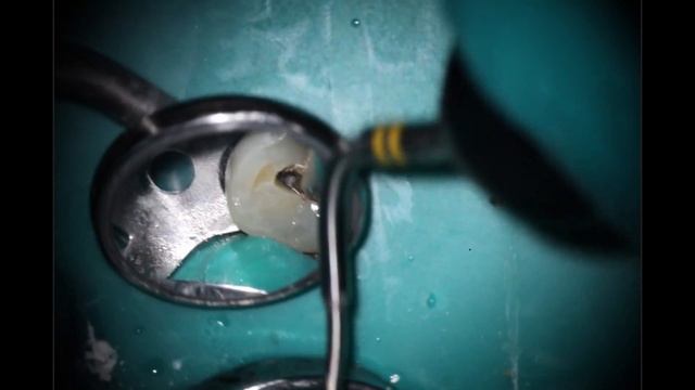 Premolar Root Canal in under 20 minutes with post! смотреть онлайн