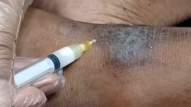 Topical kenacort for Lichenified tinea incognito left ankle смотреть онлайн