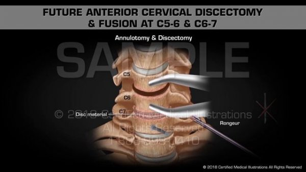 Future Anterior Cervical Discectomy & Fusion at C5-6 & C6-7 - Medical Animation