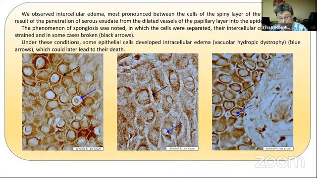 Ishchenko Irina. "3D technology in the assessment of LYVE-1 expression in skin eczema and type 2 DM смотреть онлайн