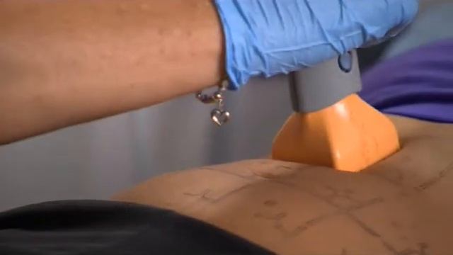 thermage смотреть онлайн