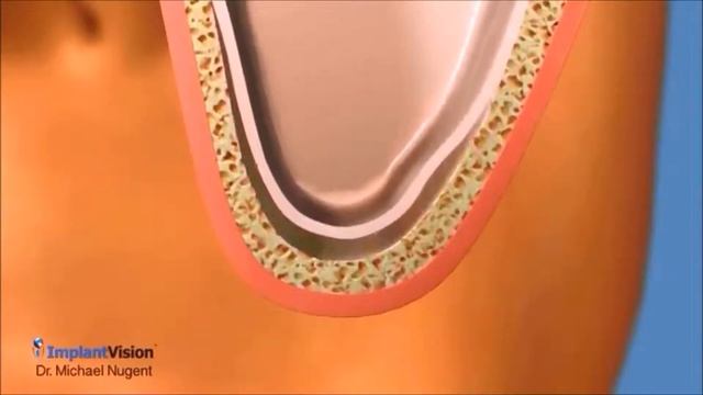 Sinus Lift and Bone Graft | Dental Implants Pasadena TX смотреть онлайн
