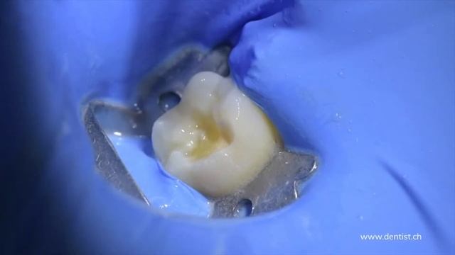 PREPARATION WITH 29 MICRON Al Ox WITH AQUACARE (SLOW-MO) BY WWW.DENTIST.CH смотреть онлайн