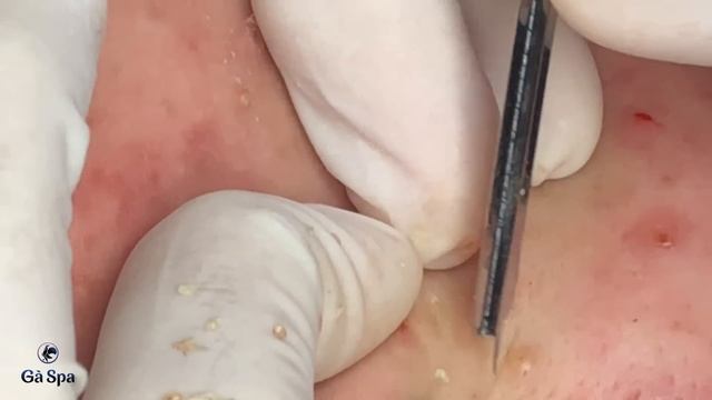SIGNATURE SERVICE: Acnes Treatment (Ver.7)
