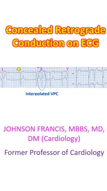 Concealed Retrograde Conduction on ECG смотреть онлайн
