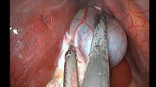laparoscopic cholecystectomy with 3D 30 degree camera single site access смотреть онлайн