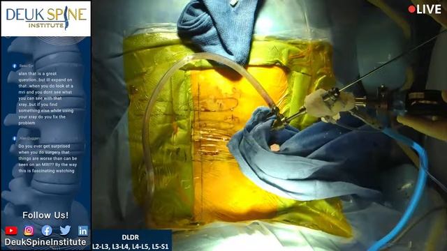 Deuk Laser Disc Repair L2-3, L3-4, L4-5,L5-S1 смотреть онлайн