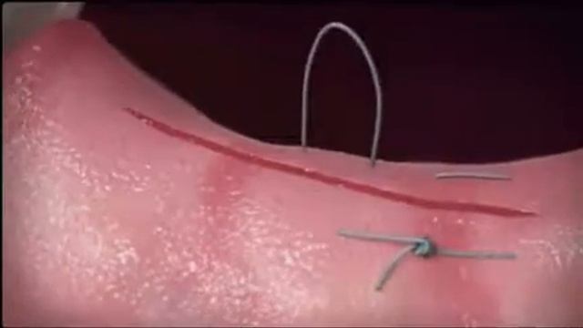 Suturing technique Техника наложения швов Tikuv Usullari смотреть онлайн
