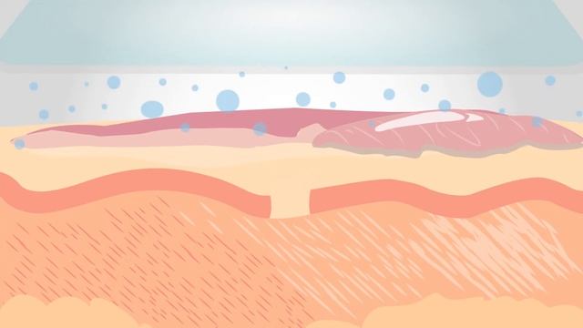 Silicone Sheeting and Scaring: How Sheeting Works on Scars смотреть онлайн