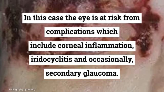 Herpes Zoster Ophthalmicus смотреть онлайн