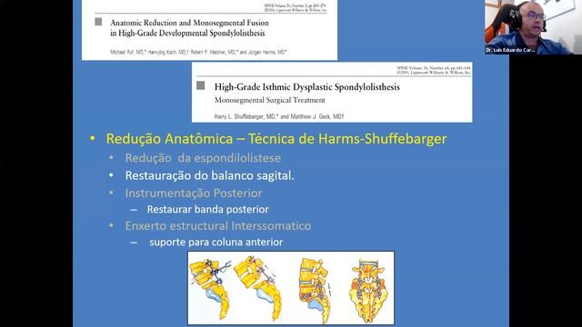 Webinar | Espondilolistese de alto grau: quando e como reduzir? смотреть онлайн