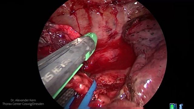duoportal VATS right segmentectomy S6 with articulating instruments and ICG application смотреть онлайн