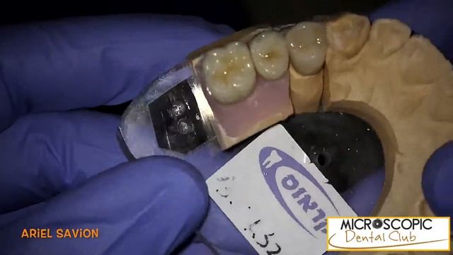 הרמת סינוס ושתלי בייקון בגישה מיקרוסקופית - ד״ר אריאל סביון - רופא שיניים במרכז смотреть онлайн