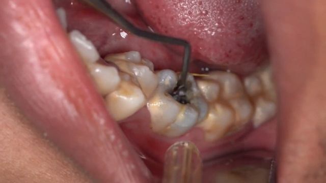 Teeth Scaling And SATISFYING Cleaning, Tartar Removal - 2023