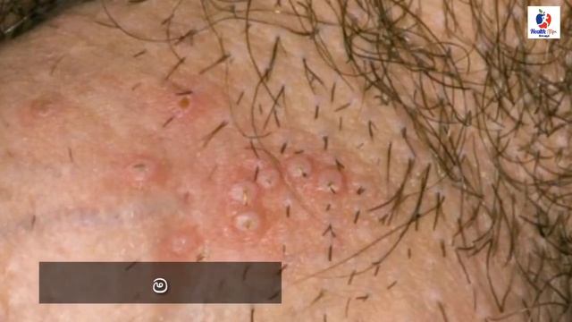 genital herpes sinhala |ලිංගික හර්පීස්. | Sinhala medical channel смотреть онлайн