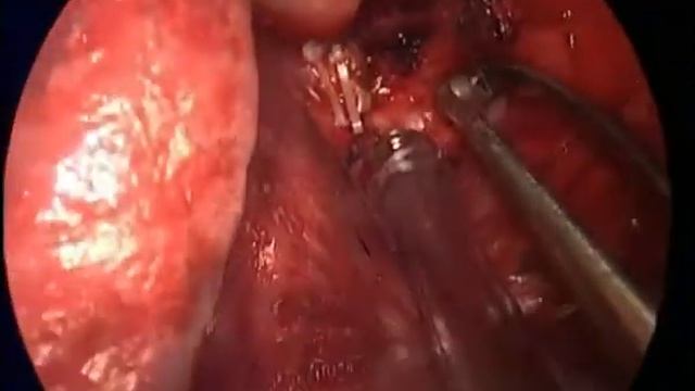 Uniportal left dorsal S6 segmentectomy by Dr.Samer Al Sawalhi смотреть онлайн