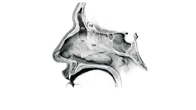 draf 3, endonasal median drainage procedure, modified lothrop procedure, смотреть онлайн
