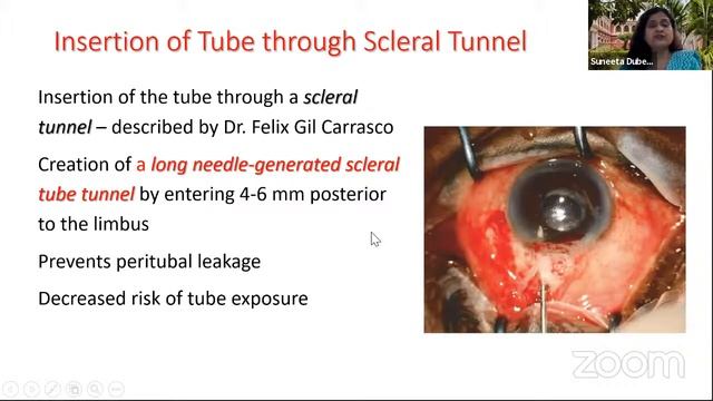 Surfing the Anterior Segment : Glaucoma Drainage Device смотреть онлайн
