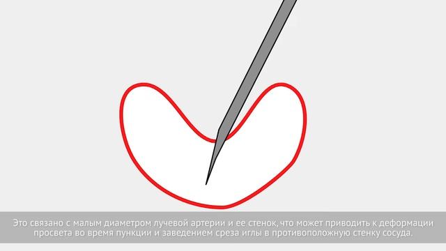 Артериальный ретроградный лучевой доступ, дистальный. смотреть онлайн