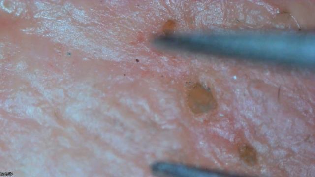 0086 角栓抜き 鼻 смотреть онлайн