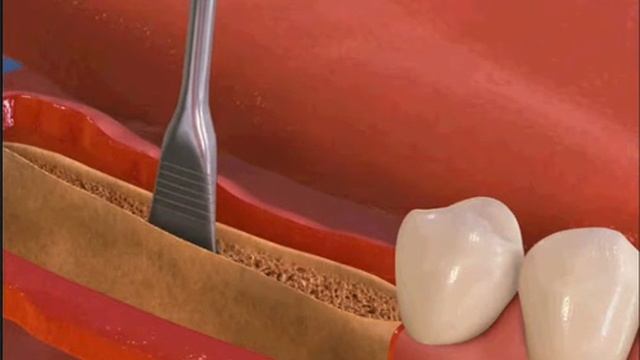 Installation of the implant, part 2 смотреть онлайн