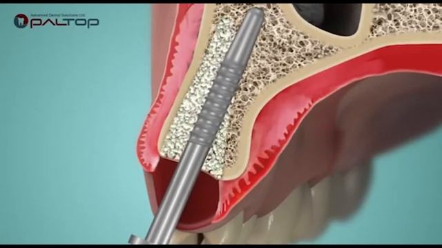 Osteotome Technique